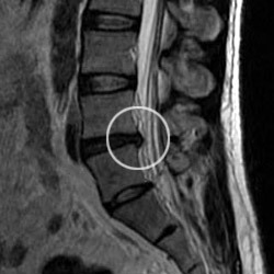 MRI scan of a herniated disc