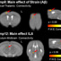 Resting state functional MRI at 11.1T revealed the effects on brain microstructures and intrinsic activity due to β-amyloid (Aβ) plaque deposits and inflammation, as indicated by the presence of the inflammatory protein interleukin-6 (IL6).