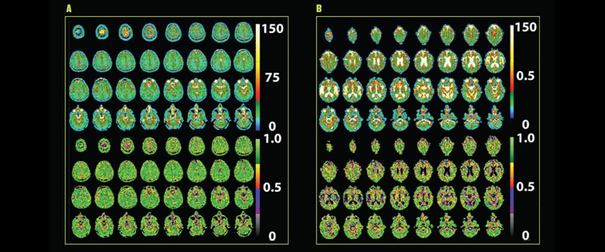 Tissue sodium concentration maps of a 24-year-old (left) and a 73-year-old (right) made in the 9.4-tesla MRI show differences in cerebrospinal fluid (white) but little variance in brain tissue (green) despite age.