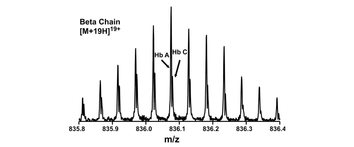 "Hb AC" denotes heterozygous β-chains: one normal, and one with a single mutation of glutamic acid to lysine at amino acid sequence position 6.