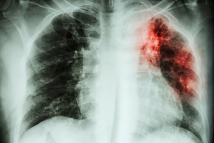 Chest x-ray of a tuberculosis infection in the lung