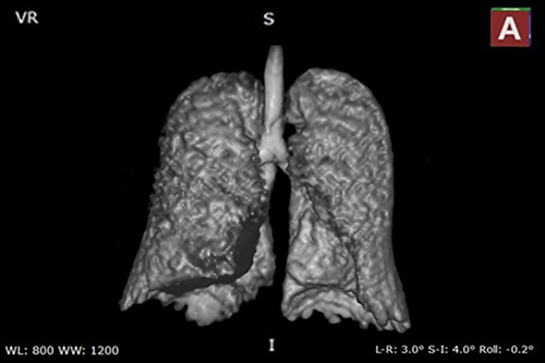 A lung image taken at the MagLab’s AMRIS facility at the University of Florida using hyperpolarized Xenon MRI