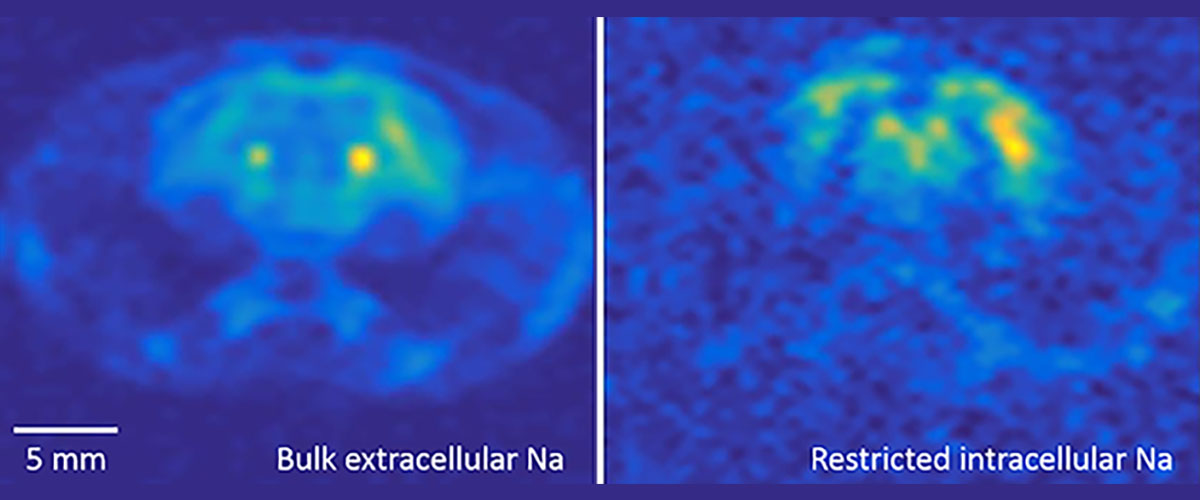 These 3D MRI images of sodium in a rat brain, acquired in the MagLab’s 21.1-tesla MRI scanner, illustrate the detail the instrument can capture. The image at right shows intracellular sodium, while the image at left shows extracellular sodium.