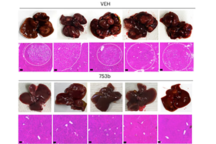 Number and volume of liver tumors based on the MRI images