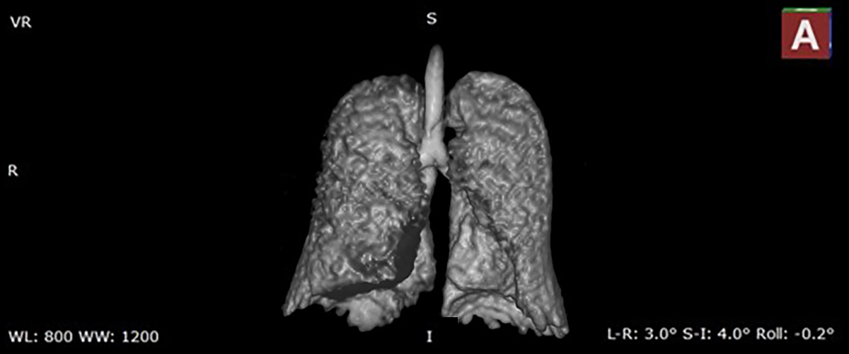 A lung image taken at the MagLab’s AMRIS facility at the University of Florida using hyperpolarized Xenon MRI