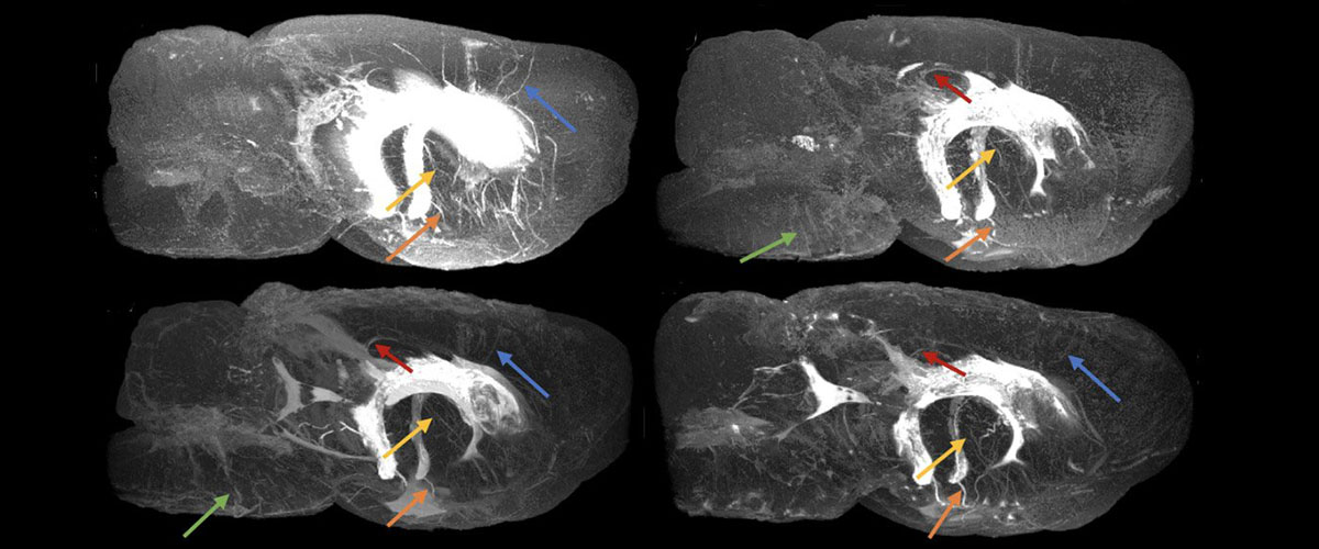 MRI images of the perivascular networks in the brains of four rats. Vessels with perivascular spaces (PVS) that appear to be common in different rats are highlighted using colored arrows.