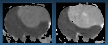 Images of a rat brain made with the 900 MHz NMR magnet. The image on the left shows the brain prior to chemotherapy; the lighter region is the tumor. The image on the right shows the area four days after chemotherapy; the lighter shading indicates more water is flowing in those tumor cells, a sign they are breaking down and that the treatment is working.